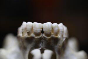 Close-up image of upper front teeth, showing linear enamel hypoplasia