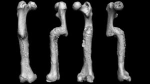 Front, back, and side views of a severely fractured femur, which healed at an angle.