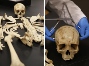 At left, a human skeleton is laid out on a table. At right, two gloved hands are holding calipers and measuring the skull.